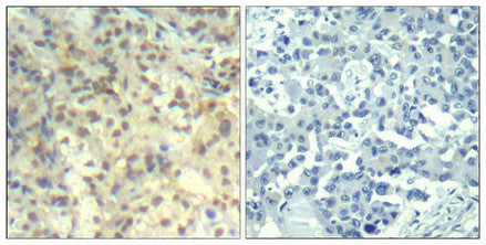 Immunohistochemical analysis of paraffin-embedded human lung carcinoma tissue using cofilin1(Phospho-Tyr139) Antibody(left) or the same antibody preincubated with blocking peptide(right).