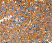 Immunohistochemical analysis of paraffin-embedded Human liver cancer tissue using at dilution 1/20.