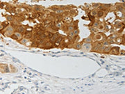 The image on the left is immunohistochemistry of paraffin-embedded Human breast cancer tissue using CSB-PA266740(PADI4 Antibody) at dilution 1/25, on the right is treated with fusion protein. (Original magnification: ×200)