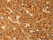 The image on the left is immunohistochemistry of paraffin-embedded Human liver cancer tissue using CSB-PA267054(RBBP9 Antibody) at dilution 1/25, on the right is treated with fusion protein. (Original magnification: ×200)
