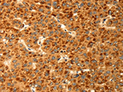 The image on the left is immunohistochemistry of paraffin-embedded Human liver cancer tissue using CSB-PA267054(RBBP9 Antibody) at dilution 1/25, on the right is treated with fusion protein. (Original magnification: ×200)