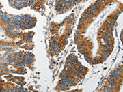 The image on the left is immunohistochemistry of paraffin-embedded Human colon cancer tissue using CSB-PA267095(MARK2 Antibody) at dilution 1/15, on the right is treated with synthetic peptide. (Original magnification: ×200)
