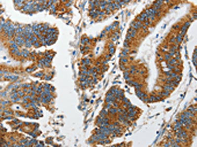 The image on the left is immunohistochemistry of paraffin-embedded Human colon cancer tissue using CSB-PA267095(MARK2 Antibody) at dilution 1/15, on the right is treated with synthetic peptide. (Original magnification: ×200)