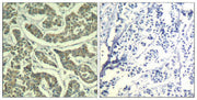 Immunohistochemical analysis of paraffin-embedded human breast carcinoma tissue using ATR(Ab-428) Antiobdy(left) or the same antibody preincubated with blocking peptide(right).