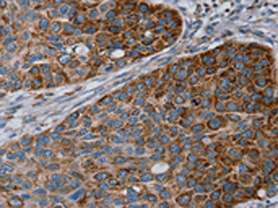 The image on the left is immunohistochemistry of paraffin-embedded Human esophagus cancer tissue using CSB-PA267290(REG4 Antibody) at dilution 1/25, on the right is treated with fusion protein. (Original magnification: ×200)