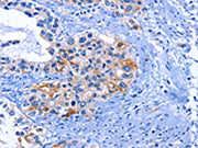The image on the left is immunohistochemistry of paraffin-embedded Human cervical cancer tissue using CSB-PA267352(CDK2 Antibody) at dilution 1/25, on the right is treated with fusion protein. (Original magnification: ×200)
