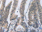 The image on the left is immunohistochemistry of paraffin-embedded Human colon cancer tissue using CSB-PA267410(F2R Antibody) at dilution 1/40, on the right is treated with synthetic peptide. (Original magnification: ×200)
