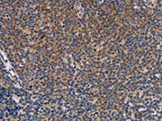 The image on the left is immunohistochemistry of paraffin-embedded Human Lymphoma tissue using CSB-PA267618(CCL23 Antibody) at dilution 1/50, on the right is treated with synthetic peptide. (Original magnification: ×200)