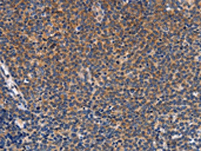 The image on the left is immunohistochemistry of paraffin-embedded Human Lymphoma tissue using CSB-PA267618(CCL23 Antibody) at dilution 1/50, on the right is treated with synthetic peptide. (Original magnification: ×200)