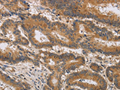 The image on the left is immunohistochemistry of paraffin-embedded Human colon cancer tissue using CSB-PA267679(ITIH1 Antibody) at dilution 1/30, on the right is treated with synthetic peptide. (Original magnification: ×200)