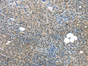 The image on the left is immunohistochemistry of paraffin-embedded Human ovarian cancer tissue using CSB-PA267854(MED15 Antibody) at dilution 1/25, on the right is treated with synthetic peptide. (Original magnification: ×200)