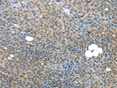 The image on the left is immunohistochemistry of paraffin-embedded Human ovarian cancer tissue using CSB-PA267854(MED15 Antibody) at dilution 1/25, on the right is treated with synthetic peptide. (Original magnification: ×200)