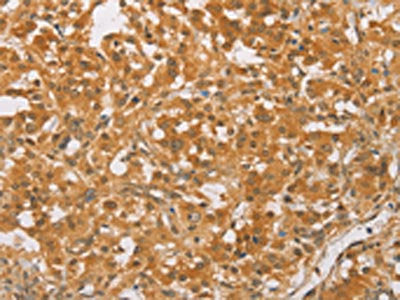 The image on the left is immunohistochemistry of paraffin-embedded Human thyroid cancer tissue using CSB-PA268568(CEBPB Antibody) at dilution 1/60, on the right is treated with synthetic peptide. (Original magnification: ×200)