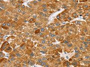 The image on the left is immunohistochemistry of paraffin-embedded Human liver cancer tissue using CSB-PA268589(SPARCL1 Antibody) at dilution 1/25, on the right is treated with synthetic peptide. (Original magnification: ×200)