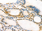 The image on the left is immunohistochemistry of paraffin-embedded Human thyroid cancer tissue using CSB-PA268943(MUC16 Antibody) at dilution 1/20, on the right is treated with synthetic peptide. (Original magnification: ×200)