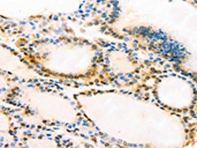 The image on the left is immunohistochemistry of paraffin-embedded Human thyroid cancer tissue using CSB-PA268943(MUC16 Antibody) at dilution 1/20, on the right is treated with synthetic peptide. (Original magnification: ×200)