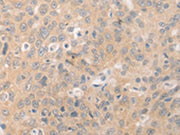 The image on the left is immunohistochemistry of paraffin-embedded Human ovarian cancer tissue using CSB-PA269030(BEST1 Antibody) at dilution 1/20, on the right is treated with synthetic peptide. (Original magnification: ×200)
