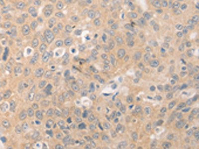 The image on the left is immunohistochemistry of paraffin-embedded Human ovarian cancer tissue using CSB-PA269030(BEST1 Antibody) at dilution 1/20, on the right is treated with synthetic peptide. (Original magnification: ×200)