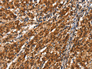 The image on the left is immunohistochemistry of paraffin-embedded Human gastic cancer tissue using CSB-PA269084(CYP2D6 Antibody) at dilution 1/40, on the right is treated with synthetic peptide. (Original magnification: ×200)