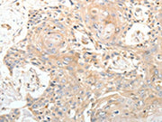 The image on the left is immunohistochemistry of paraffin-embedded Human esophagus cancer tissue using CSB-PA269128(STX1A Antibody) at dilution 1/20, on the right is treated with synthetic peptide. (Original magnification: ×200)