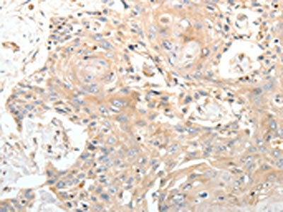 The image on the left is immunohistochemistry of paraffin-embedded Human esophagus cancer tissue using CSB-PA269128(STX1A Antibody) at dilution 1/20, on the right is treated with synthetic peptide. (Original magnification: ×200)