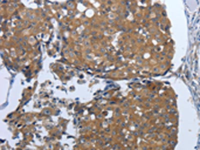 The image on the left is immunohistochemistry of paraffin-embedded Human breast cancer tissue using CSB-PA269141(PDIA2 Antibody) at dilution 1/50, on the right is treated with synthetic peptide. (Original magnification: ×200)