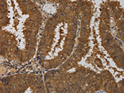The image on the left is immunohistochemistry of paraffin-embedded Human colon cancer tissue using CSB-PA269153(TAB1 Antibody) at dilution 1/50, on the right is treated with fusion protein. (Original magnification: ×200)