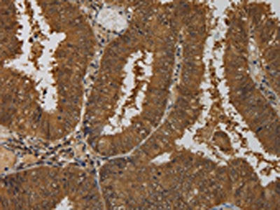 The image on the left is immunohistochemistry of paraffin-embedded Human colon cancer tissue using CSB-PA269153(TAB1 Antibody) at dilution 1/50, on the right is treated with fusion protein. (Original magnification: ×200)