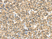The image on the left is immunohistochemistry of paraffin-embedded Human thyroid cancer tissue using CSB-PA269233(ME1 Antibody) at dilution 1/35, on the right is treated with synthetic peptide. (Original magnification: ×200)