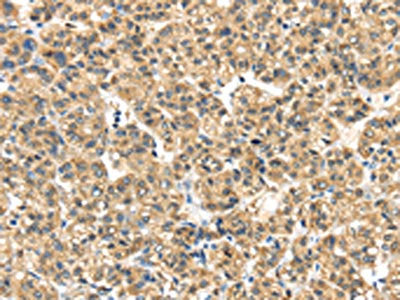 The image on the left is immunohistochemistry of paraffin-embedded Human thyroid cancer tissue using CSB-PA269233(ME1 Antibody) at dilution 1/35, on the right is treated with synthetic peptide. (Original magnification: ×200)