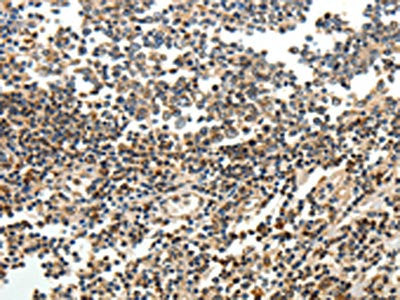 The image on the left is immunohistochemistry of paraffin-embedded Human tonsil tissue using CSB-PA269266(SERPINF1 Antibody) at dilution 1/15, on the right is treated with fusion protein. (Original magnification: ×200)