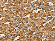 The image on the left is immunohistochemistry of paraffin-embedded Human liver cancer tissue using CSB-PA269342(STK32B Antibody) at dilution 1/25, on the right is treated with synthetic peptide. (Original magnification: ×200)