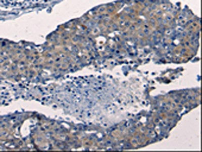 The image on the left is immunohistochemistry of paraffin-embedded Human breast cancer tissue using CSB-PA270018(FGF2 Antibody) at dilution 1/50, on the right is treated with synthetic peptide. (Original magnification: ×200)
