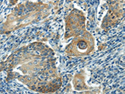 The image on the left is immunohistochemistry of paraffin-embedded Human cervical cancer tissue using CSB-PA270025(IL-20 Antibody) at dilution 1/35, on the right is treated with synthetic peptide. (Original magnification: ×200)