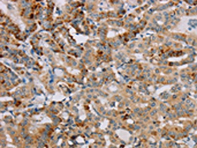 The image on the left is immunohistochemistry of paraffin-embedded Human thyroid cancer tissue using CSB-PA270132(PPP1R12A Antibody) at dilution 1/25, on the right is treated with fusion protein. (Original magnification: ×200)