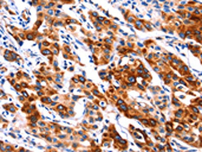 The image on the left is immunohistochemistry of paraffin-embedded Human lung cancer tissue using CSB-PA270601(SEPT4 Antibody) at dilution 1/50, on the right is treated with synthetic peptide. (Original magnification: ×200)