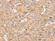 The image on the left is immunohistochemistry of paraffin-embedded Human liver cancer tissue using CSB-PA270713(SLIT3 Antibody) at dilution 1/30, on the right is treated with synthetic peptide. (Original magnification: ×200)