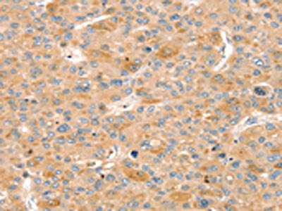 The image on the left is immunohistochemistry of paraffin-embedded Human liver cancer tissue using CSB-PA270713(SLIT3 Antibody) at dilution 1/30, on the right is treated with synthetic peptide. (Original magnification: ×200)