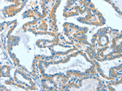 The image on the left is immunohistochemistry of paraffin-embedded Human thyroid cancer tissue using CSB-PA270829(ASCC1 Antibody) at dilution 1/50, on the right is treated with fusion protein. (Original magnification: ×200)