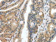 The image on the left is immunohistochemistry of paraffin-embedded Human thyroid cancer tissue using CSB-PA271019(USP28 Antibody) at dilution 1/35, on the right is treated with synthetic peptide. (Original magnification: ×200)