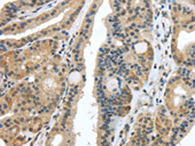 The image on the left is immunohistochemistry of paraffin-embedded Human thyroid cancer tissue using CSB-PA271019(USP28 Antibody) at dilution 1/35, on the right is treated with synthetic peptide. (Original magnification: ×200)