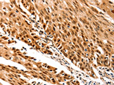 The image on the left is immunohistochemistry of paraffin-embedded Human cervical cancer tissue using CSB-PA271046(TRIM63 Antibody) at dilution 1/70, on the right is treated with synthetic peptide. (Original magnification: ×200)