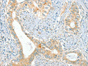 The image on the left is immunohistochemistry of paraffin-embedded Human cervical cancer tissue using CSB-PA271234(ACE Antibody) at dilution 1/80, on the right is treated with synthetic peptide. (Original magnification: ×200)