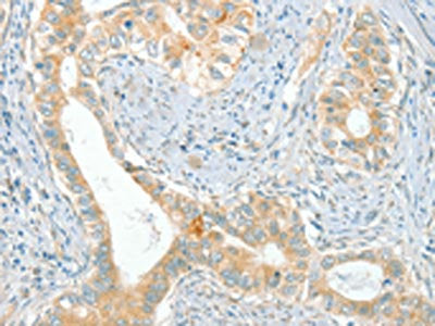 The image on the left is immunohistochemistry of paraffin-embedded Human cervical cancer tissue using CSB-PA271234(ACE Antibody) at dilution 1/80, on the right is treated with synthetic peptide. (Original magnification: ×200)