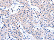 The image on the left is immunohistochemistry of paraffin-embedded Human lung cancer tissue using CSB-PA271275(ACTR3B Antibody) at dilution 1/15, on the right is treated with fusion protein. (Original magnification: ×200)