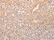 The image on the left is immunohistochemistry of paraffin-embedded Human liver cancer tissue using CSB-PA271288(TRPC3 Antibody) at dilution 1/50, on the right is treated with synthetic peptide. (Original magnification: ×200)