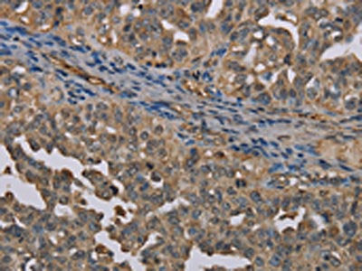 The image on the left is immunohistochemistry of paraffin-embedded Human ovarian cancer tissue using CSB-PA271355(UBP1 Antibody) at dilution 1/40, on the right is treated with synthetic peptide. (Original magnification: ×200)