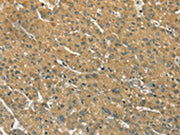 The image on the left is immunohistochemistry of paraffin-embedded Human liver cancer tissue using CSB-PA271363(S100A6 Antibody) at dilution 1/35, on the right is treated with synthetic peptide. (Original magnification: ×200)