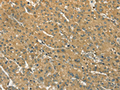 The image on the left is immunohistochemistry of paraffin-embedded Human liver cancer tissue using CSB-PA271363(S100A6 Antibody) at dilution 1/35, on the right is treated with synthetic peptide. (Original magnification: ×200)