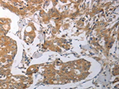 The image on the left is immunohistochemistry of paraffin-embedded Human breast cancer tissue using CSB-PA271756(SHH Antibody) at dilution 1/70, on the right is treated with synthetic peptide. (Original magnification: ×200)